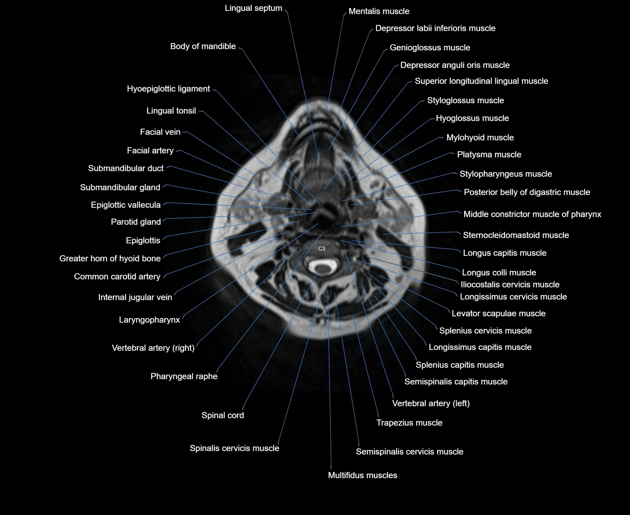 MRI Neck 3D labelled cross section anatomy axial 3t image-00001-00044.webp